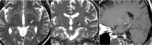 脑干海绵状血管瘤需不需要手术？手术指征及手术获益
