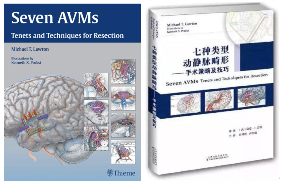 世界神经血管外科大师Lawton教授神作《七种脑动静脉畸形》系列——胼胝体AVM解剖及手术策略