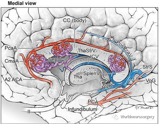 胼胝体AVM,内侧面观。胼胝体AVM位于胼胝体，范围从胼胝体嘴到压部；在膝、体和压部显示三种不同的胼胝体AVM。它们由ACA和PcaA发出的分支（胝体长、短动脉）供血，向深部引流到脑室静脉(前、后隔静脉(SepV),尾状核前、后静脉(CauV),和丘纹静脉(ThaStrV))。