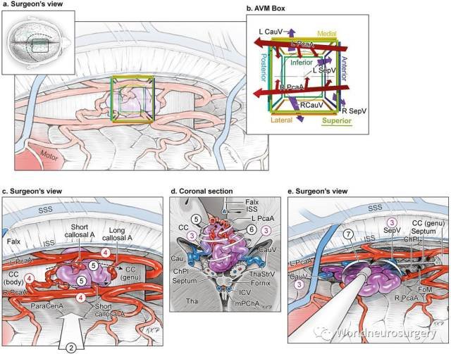 胼胝体AVM的切除策略：胼胝体AVM手术切除策略7步走