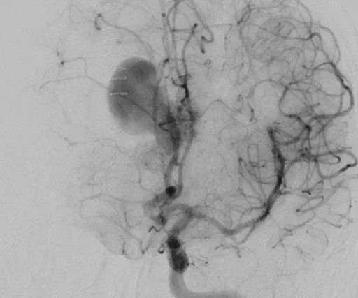 患者案例1：该患者为47岁男性，表现为合并胼胝体AVM的较大胼周动脉瘤破裂后昏迷（补充Spetzler-Martin分级为6级:S2V1E0/A3B0C0)。