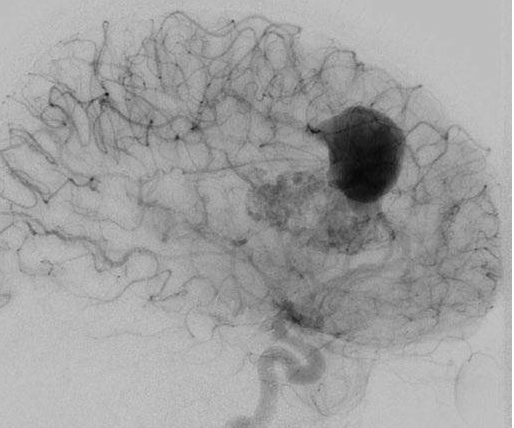 患者案例1：该患者为47岁男性，表现为合并胼胝体AVM的较大胼周动脉瘤破裂后昏迷（补充Spetzler-Martin分级为6级:S2V1E0/A3B0C0)。