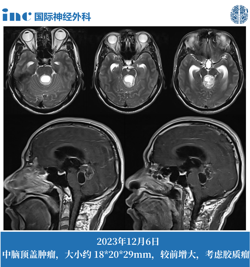 贺先生36岁男性-脑干中脑顶盖肿瘤并发梗阻性脑积水
