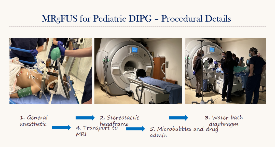 小儿DIPG的MRgFUS-治疗流程及细节