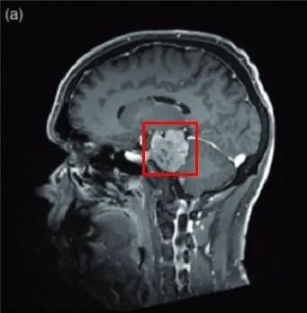 53岁男士-岩斜区脑膜瘤复杂位置，还能安全手术吗？