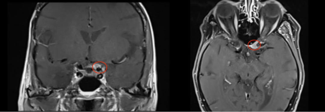 75岁女性-视神经管脑膜瘤，肿瘤切除与好转视力如何兼得？