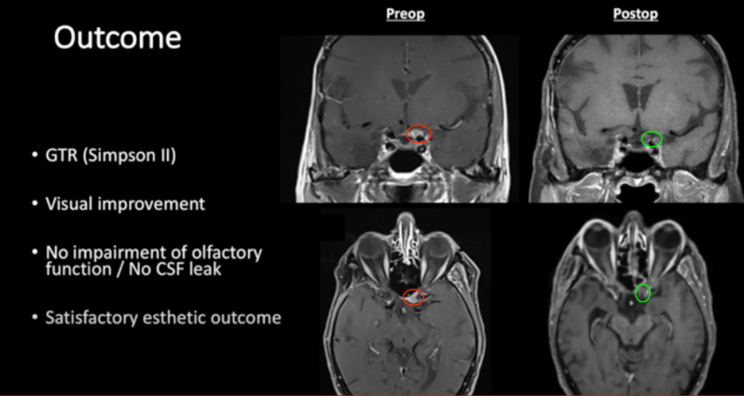 术前及术后磁共振成像。术前preop（A）和术后Postop（C）显示肿瘤完全切除，视神经保留完好，无脑水肿、出血等。