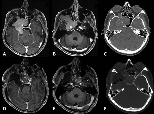 53岁男性-复发性Meckel’s腔脑膜瘤，内镜辅助显微外科切除双镜联合手术