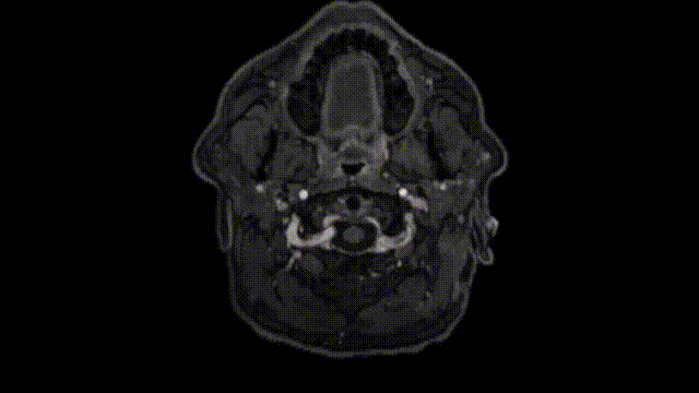 术后神经影像学检查