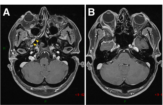 图1A-D:术前MR显示蝶眶区脑膜瘤占位，增强病灶，浸润延伸至蝶腭窝(黄色箭头)。