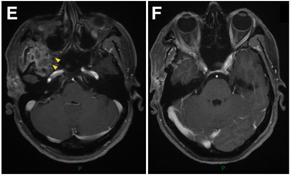 术后影像复查：证实肿瘤被完全切除。E-H:术后轴位MR图像显示肿瘤完全切除。