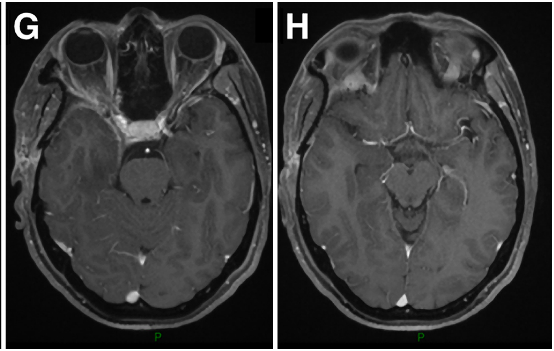 术后影像复查：证实肿瘤被完全切除。E-H:术后轴位MR图像显示肿瘤完全切除。