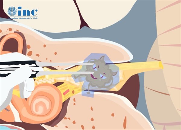 前庭神经鞘瘤