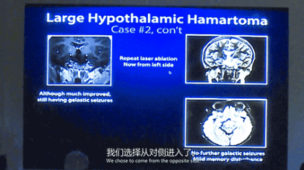 新兴微创激光技术LITT的合适性