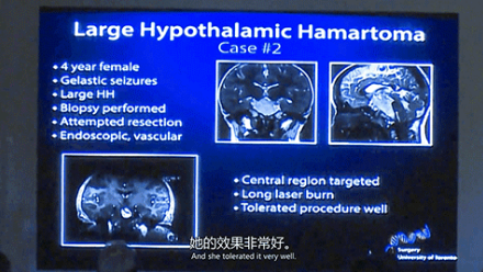 新兴微创激光技术LITT的合适性