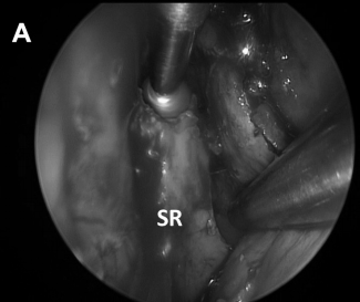行了对侧单侧入路和宽蝶窦切开术