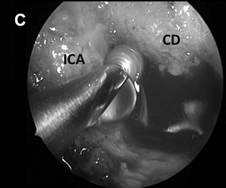 在颈内动脉(ICA)后方轻柔钻孔，避免损伤颈内动脉导致出血