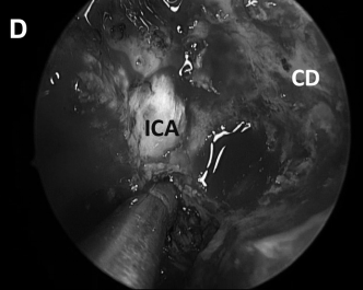 切开ICA颈内动脉下方的破裂孔处的韧带
