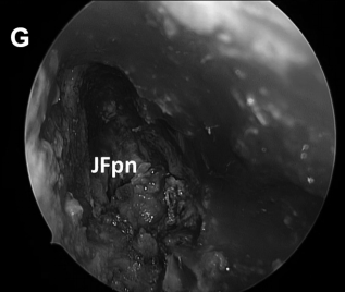 然后肿瘤被切除。在图8G中，可见肿瘤基底部暴露，并且颈静脉孔神经部组织可以通过组织质地来区分。
