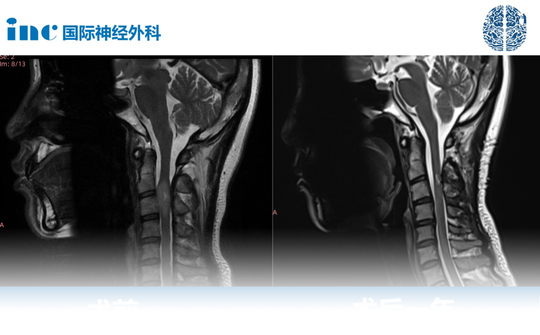 高位<a href='/bingzhong/jszl/' target='_blank'><u>脊髓肿瘤</u></a>真实案例