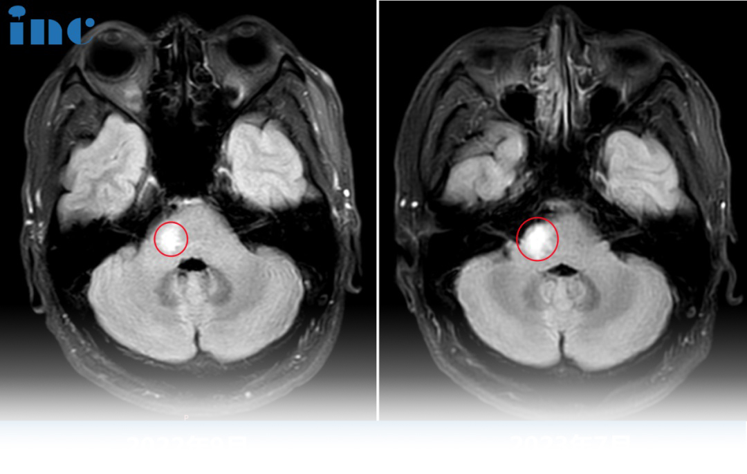 33岁男性--脑干桥臂胶质瘤