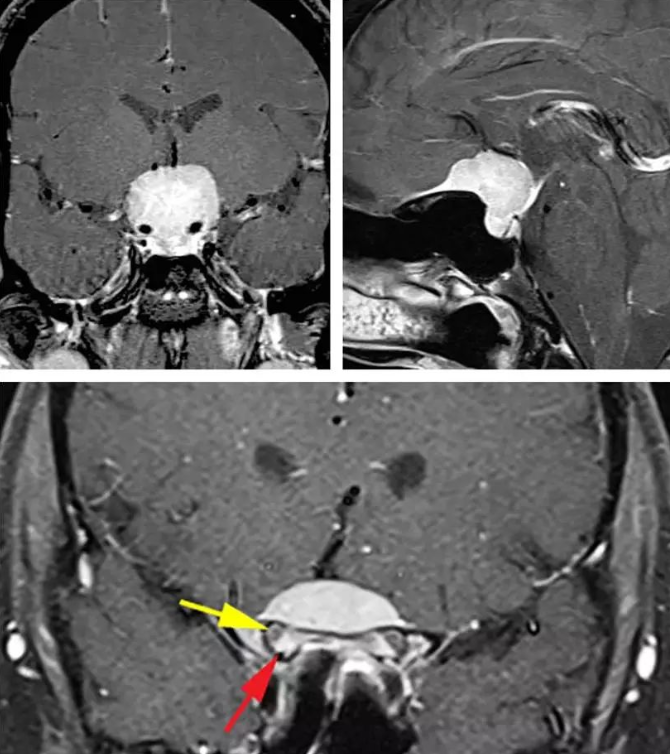 图：典型的鞍结节脑膜瘤体积大并且挤压、包绕血管。肿瘤的影像学表现也非常具有特征性：鞍内不扩大（左上图）和额底可见脑膜尾征（右下图）。下图提示病变已经累及双侧视神经管，而且以右侧为甚。红色箭头指的是视管内强化的肿瘤，黄色箭头则是指被移位的视神经。