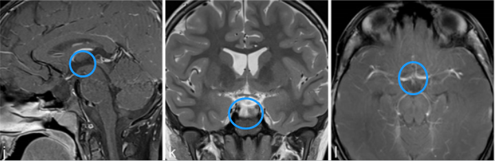 j、k、l图显示，肿瘤得到全切，术后2年没有复发，目前孩子在接受激素替代疗法