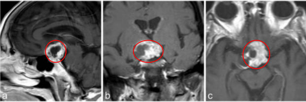 a–c图中，MR成像显示鞍上部分实性，部分囊性对比增强病变，高度可疑的颅咽管瘤。