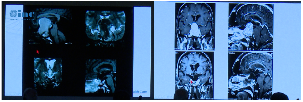 Couldwell教授演讲中展示的部分较大垂体瘤