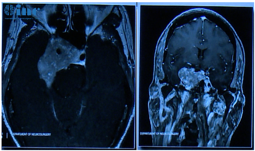 62岁女性，患者35年前有垂体大腺瘤复发史，随后接受放射治疗复发性肿瘤引起的侧性眼球麻痹的进行性复视。