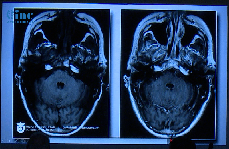 62岁女性，患者35年前有垂体大腺瘤复发史，随后接受放射治疗复发性肿瘤引起的侧性眼球麻痹的进行性复视。