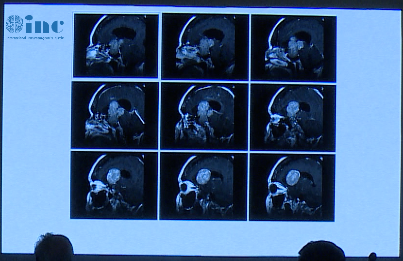 术前影像显示肿瘤较大