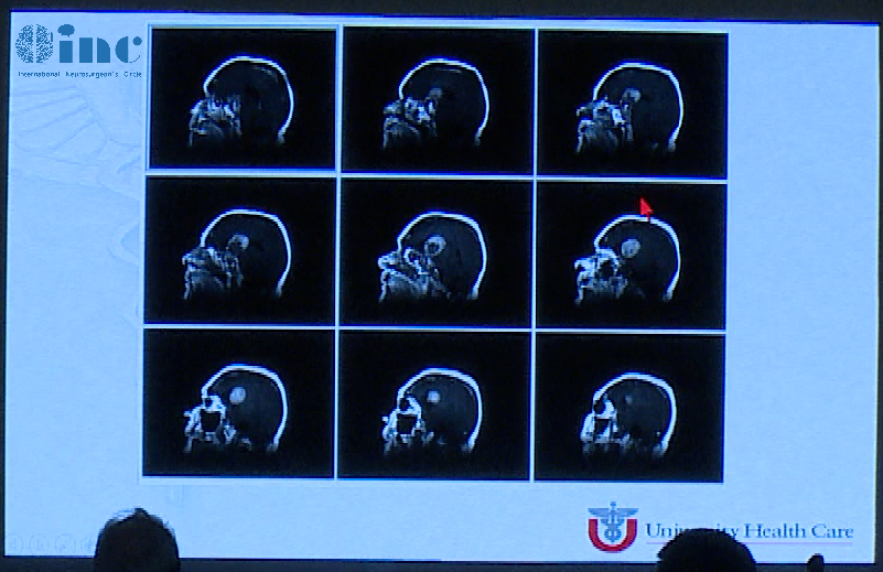 术后影像，肿瘤体积明显缩小