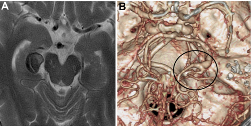 PTA在动脉瘤远端分支（图2A和2B）。予以右侧颞下入路手术，切除梭状回的一小部分被软膜，暴露动脉瘤顶端。随后，暴露动脉瘤的近端和远端颈，并识别PTA和P3段。