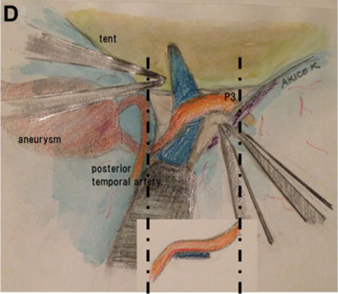 P3段被选为搭桥血管位置(图2C和2D)。如上所述,教授进行了STA-P3旁路手术并孤立动脉瘤。为了夹住动脉瘤,Kawashima教授使用了直长夹和有孔夹的组合,以避免P3段和PTA扭结。