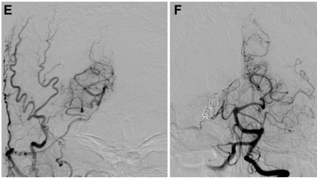 此后,通过吲哚菁绿荧光血管造影证实旁路、P3段和PTA的通畅。Kawashima教授打开动脉瘤以确保其完全闭塞并继续进行血栓切除术。患者出院时没有出现任何神经功能缺损,并且在1年随访时,旁路仍然通畅,并成功通过手术孤立了动脉瘤(图2E和2F)。