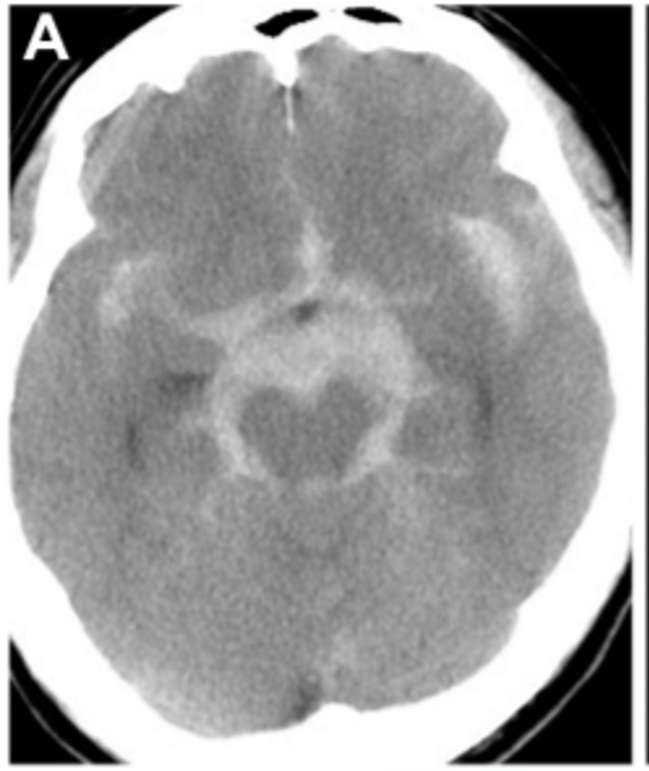 ▼A、CT显示弥漫性蛛网膜下腔出血，尤其是左侧脑桥前池增厚.