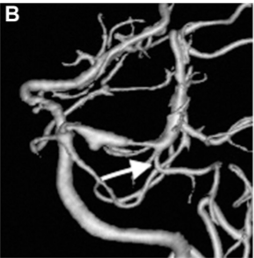 出血后第18天的延迟血管造影显示左侧P1-P2段有一个不断增长的夹层动脉瘤，并具有狭窄特征（图3B）。