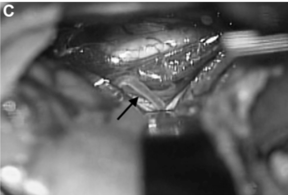 20天,经左颞下入路进行动脉瘤鼓励术和STA-PCA搭桥重建手术。初期夹闭动脉瘤的近端部分,同时保留丘脑穿支动脉。动脉瘤的解剖区域延伸到P2段后部,就在PTA分支点之前。在本例中,选择PTA作为受体动脉,因为其口径和角度优于P3段进行吻合(图3C和3D)。