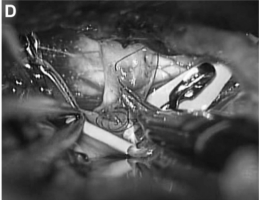 20天,经左颞下入路进行动脉瘤鼓励术和STA-PCA搭桥重建手术。初期夹闭动脉瘤的近端部分,同时保留丘脑穿支动脉。动脉瘤的解剖区域延伸到P2段后部,就在PTA分支点之前。在本例中,选择PTA作为受体动脉,因为其口径和角度优于P3段进行吻合(图3C和3D)。