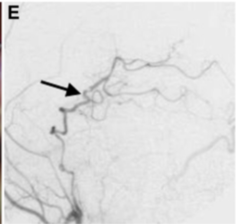 E:术后1周的颈外动脉血管造影显示整个左PCA的旁路血液供应良好(箭头)