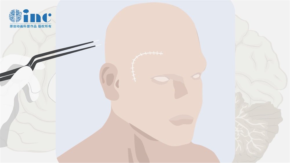 右侧脑动静脉畸形