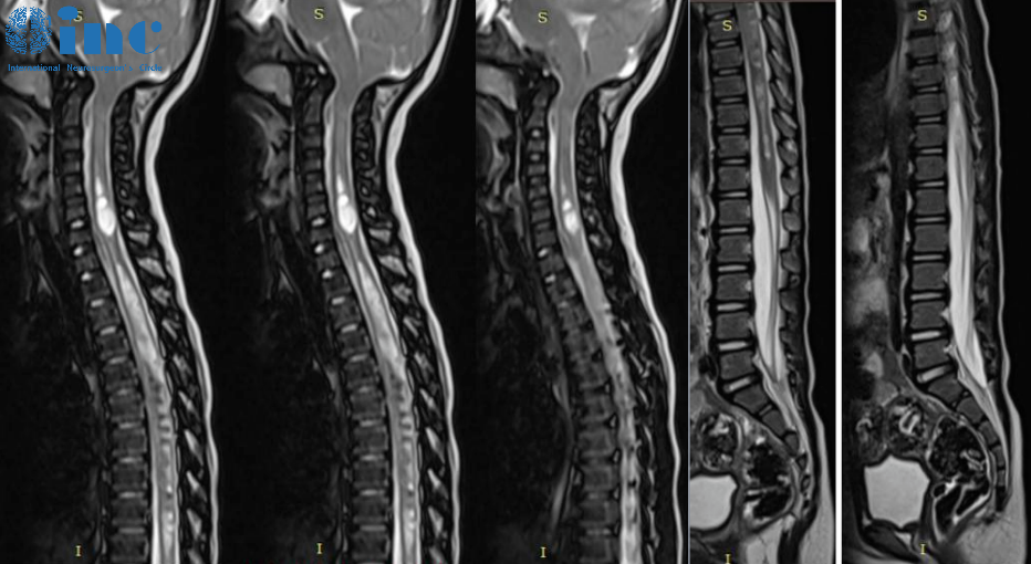 脊髓MRI检查