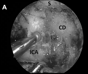 磨除骨质，暴露右侧斜坡旁的颈内动脉（ICA），注意血管保护（A）