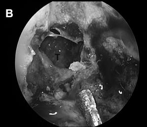 进行斜坡凹陷处（CD）和海绵窦内壁骨质磨除，暴露肿瘤包膜的内侧边缘（B）
