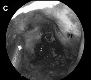 术中见胆固醇肉芽肿包膜，进行切除并送标本活检后，逐渐切除肿瘤病变（图6C）。