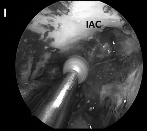 （I）s使用磨钻去除该区域粘附于岩骨的病变包膜，但切除岩骨深处病变的增强部分考虑是不安全的，因为它与内听神经关系密切。