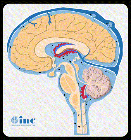 23岁女孩脑室AVM伽马刀治疗后再次出血，Lawton教授顺利全切