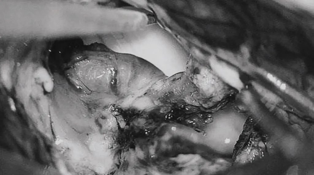 (g)引流静脉变黑。