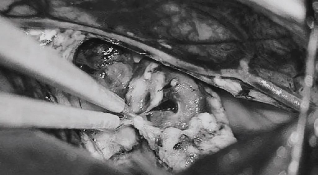 (h)引流静脉进入ICV处电凝。完全切除AVM。